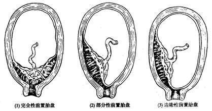 35周胎盘厚度23mm正常吗