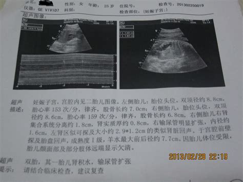 怀双胞胎前三个月孕酮