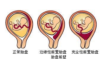 胎盘后壁对孕妇有什么影响