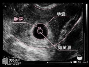 怀孕15周胎儿稳定了吗