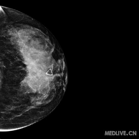乳腺癌早期的症状