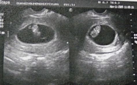怀孕三个月内胎儿的位置图片