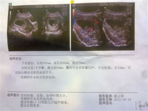 孕囊数据是两个怎么看第三个数据