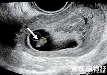 怀孕生气会导致卵黄囊增大吗