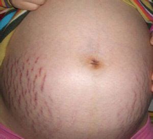 孕后妊娠纹能恢复吗