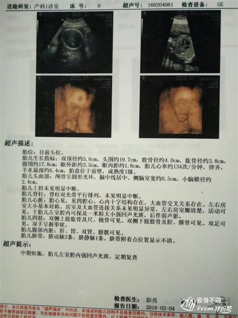 怀孕26周胎儿股骨长是多少