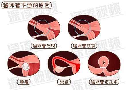 宫外孕和胎停哪个严重