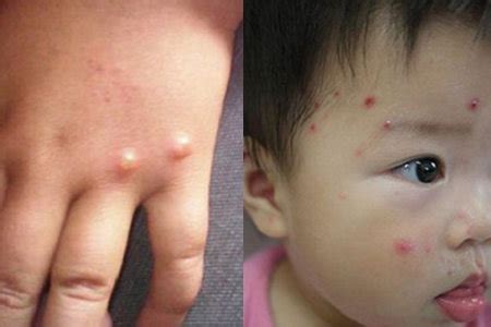 孕晚期出水痘对宝宝有什么影响