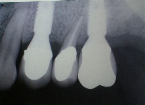 牙槽骨吸收严重可以恢复吗