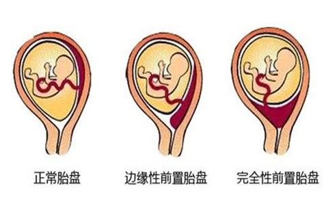 胎盘厚39mm正常吗