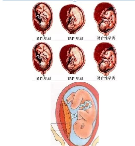 孕期要了解的胎盘发育