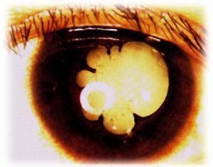 白内障发展的几个阶段