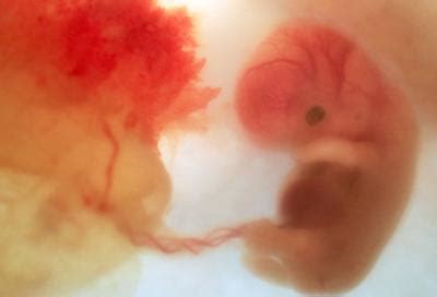 六个月的胎儿引产过程