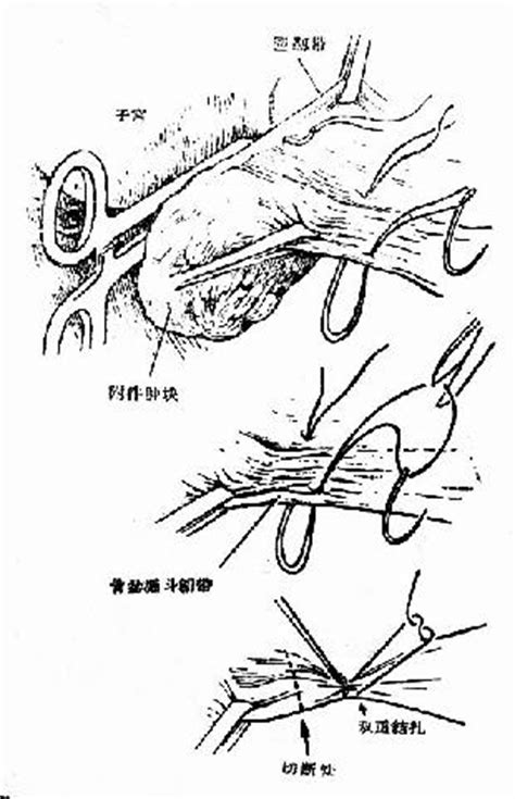 子宫切除要开腹吗