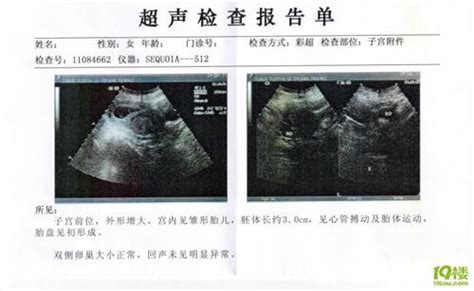 怀孕8周孕囊大小
