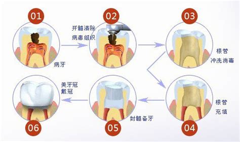 宁波种牙纳入医保项目吗